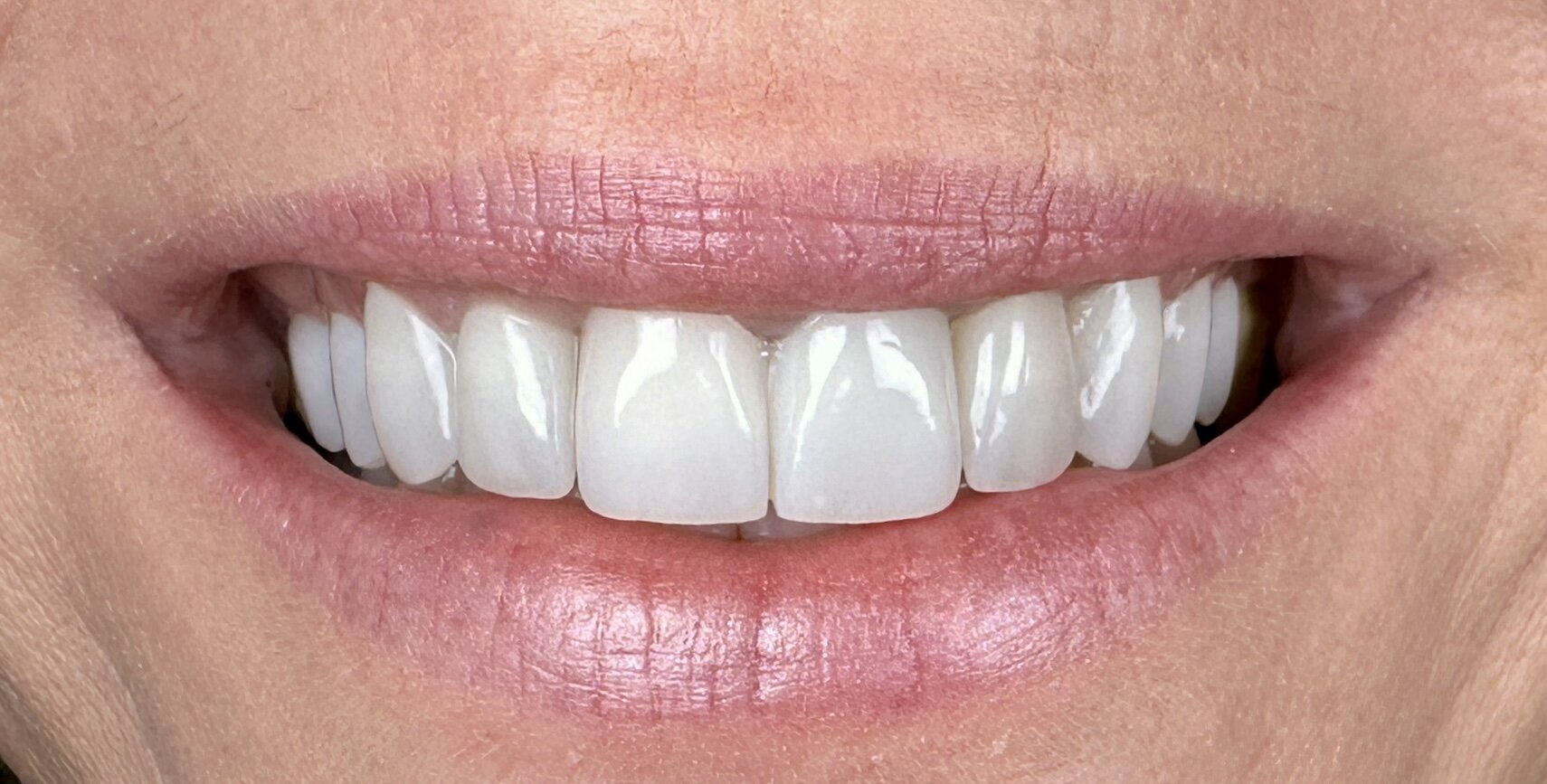 Poslije Digital Smile Design zahvata