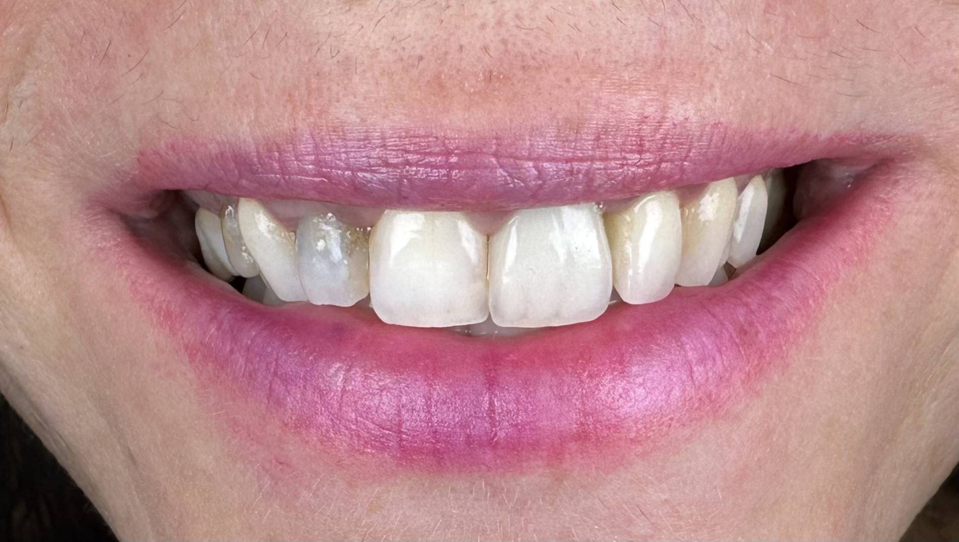 Prije Digital Smile Design zahvata